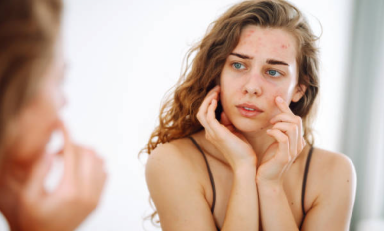 How Can You Reduce Pimple Redness and Swelling Quickly?